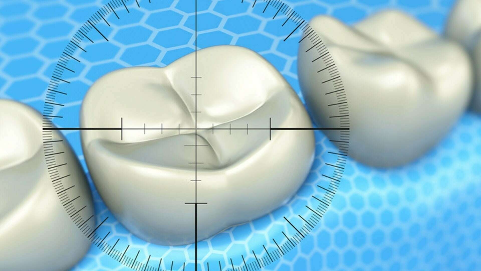 Planification implantaire 3D